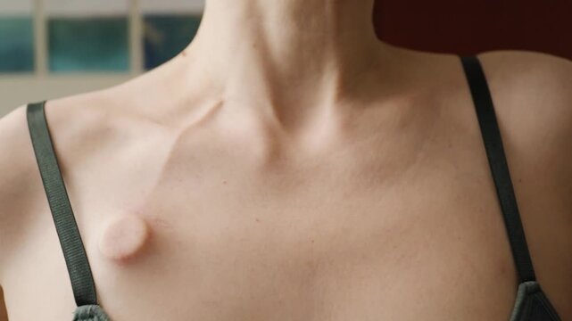 tight close-up of a chemotherapy port beside a bra strap and fingertips, emphasizing chest sensitivity, medical access and the everyday reality of living with an implanted device
