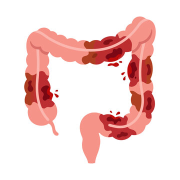 Human colon inflammation illustration showing ulcerative colitis disease, bowel cancer, and intestinal infection