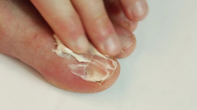 The finger is smeared with a medicinal ointment for fungus
