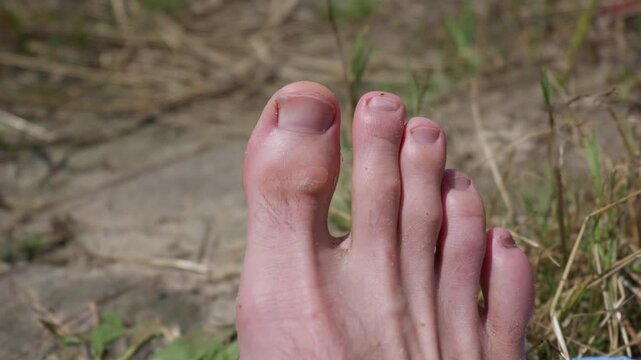 A detailed close-up shot of a human foot showing a prominent callus on the big toe joint outdoors. Concept of podiatry, skin health issues, friction damage, dermatology, and barefoot care.