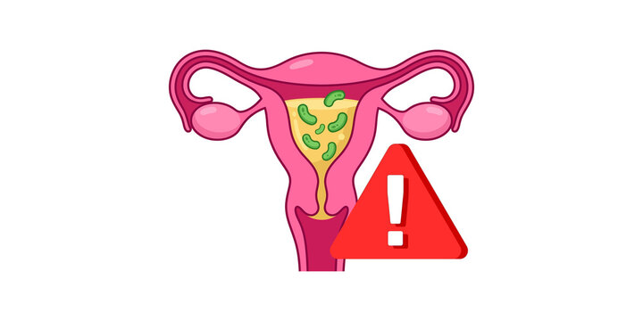 Uterine infection concept with microbes and exclamation alert icon.
