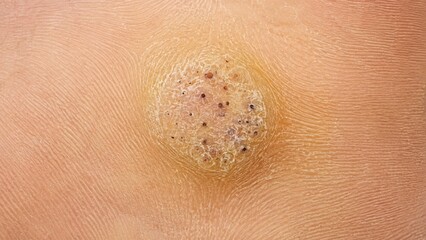 Fototapeta premium Clinical macro of plantar wart on foot sole