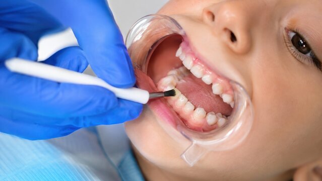 Pediatric dentist applying fluoride varnish to child's tooth