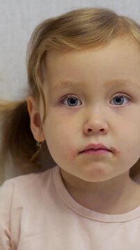 Close up portrait of a toddler girl with a sad expression showing symptoms of herpes simplex virus around her mouth, with visible sores and blisters on her skin from the infection