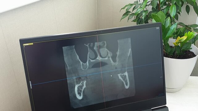 Dental CT Scan Coronal Slice View on Monitor for Oral Surgery Planning. Dental