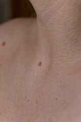 Fototapeta premium Close-Up of Human Skin Texture with Benign Moles on Neck and Collarbone, Dermatology and Skin Health Concept 