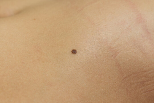 Close Up of Raised Dark Mole on Human Skin with Visible Texture and Natural Skin Details	

