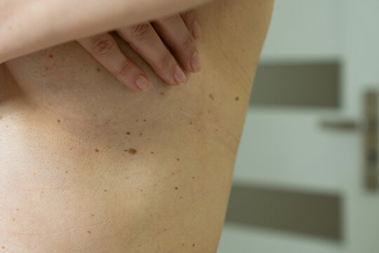 Close Up of Multiple Skin Moles and Raised Nevus on Human Skin in Under Breast Area	
