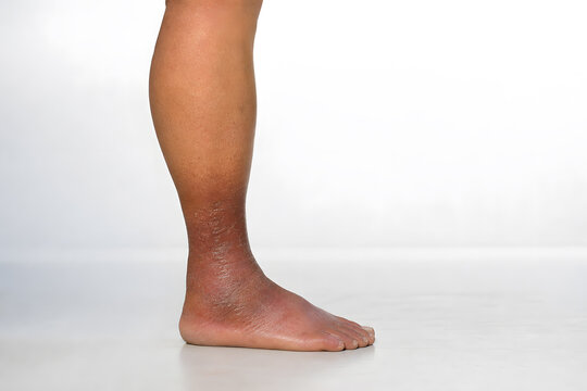 Side profile of leg with lipodermatosclerosis and skin fibrosis