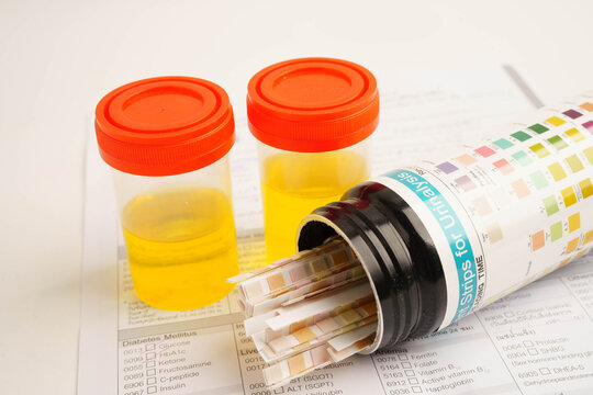 Urinalysis, urine cup with reagent strip pH paper test and comparison chart in laboratory.