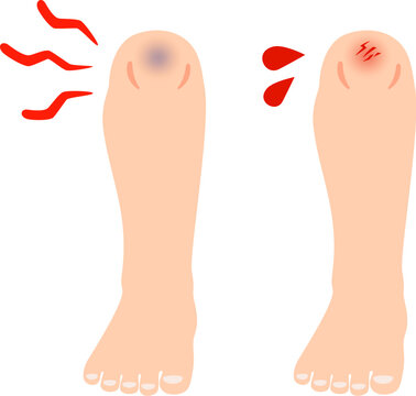 青痣ができた膝と擦り傷ができた膝