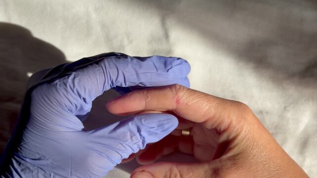 Doctor hands in gloves examining damaged dry peeling skin on patient finger, eczema