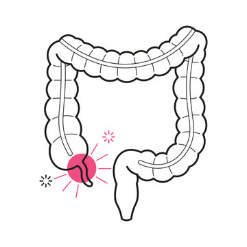 Appendicitis Pain Vector Illustration with Inflamed Human Appendix Anatomy Design