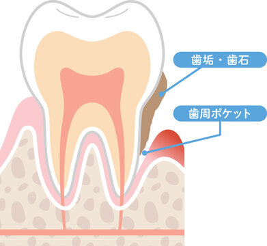 歯周炎の断面図　歯垢と歯周ポケット