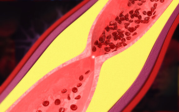 Medical 3D illustration showing yellow cholesterol plaque buildup narrowing a human blood artery.