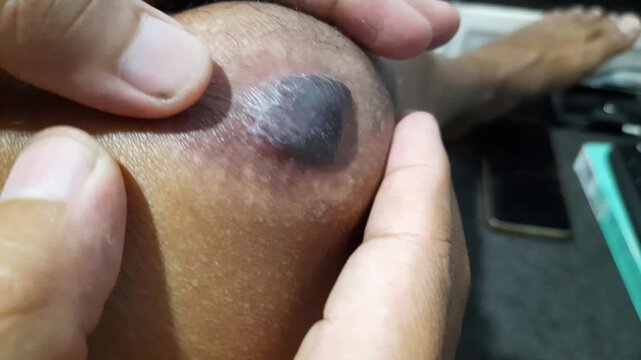 Close up of a severe blood blister and skin hematoma on knee caused by an accidental bump