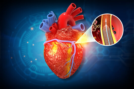 Human heart anatomy featuring a coronary artery with a metallic stent implantation. 3d illustration