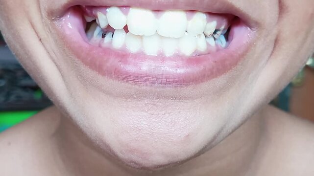 Tooth decay in children is caused by the accumulation of plaque containing bacteria that convert sugars from food and drinks into acids that then erode tooth enamel, causing cavities or caries.