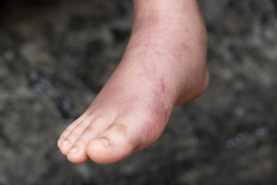 Swollen Foot After Cast Removal of Metatarsal Fracture