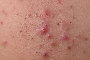 Fototapeta premium Facial skin showing inflamed acne lesions in close up