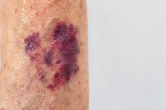 Senile Purpura on Forearm of Older Adult Showing Age Related Skin Bruising Close Up