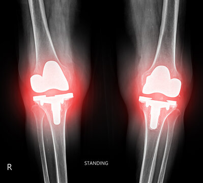 Standing anteroposterior X-ray of both knees after total knee replacement surgery, with red highlight on the prosthetic joints on black background.