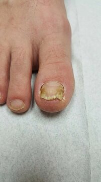 Nail fungus infection: damaged keratin, yellow discoloration, diseased toe, fungal growth, unhealthy cuticle, crumble plate, dermatophyte pathogen, foot disease.