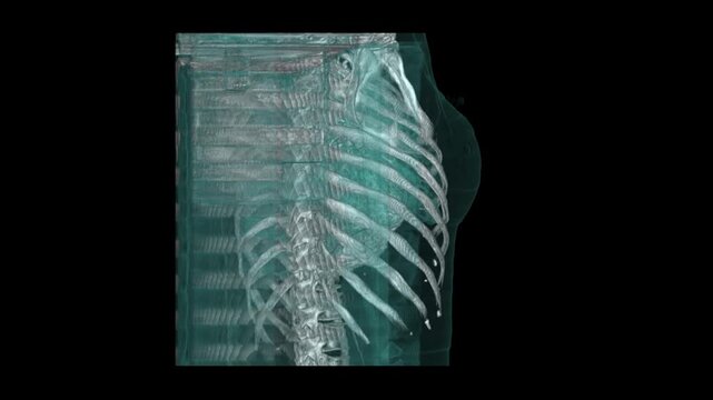 3D Cyan Volume Rendering CECT Thorax Scan Rotating View Showing Heart Aorta and Rib Cage Skeleton