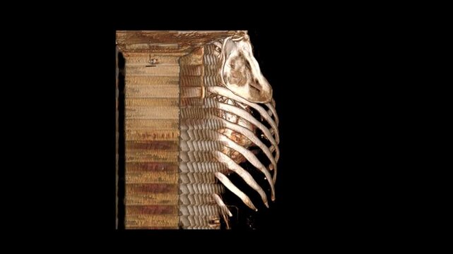 3D Cinematic CECT Thorax Volume Rendering Rotating View of Heart Aorta Coronary Arteries and Thoracic Rib Cage