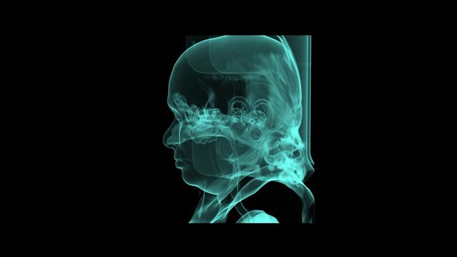 CT Brain Angiography Volume Rendering Showing Intracranial Vascular Network Cerebral Vessels and Facial Skeleton Profile
