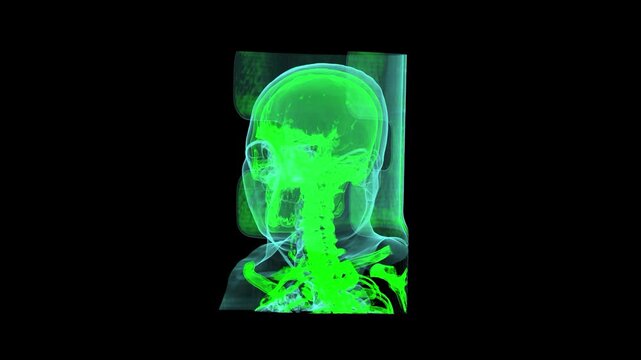 3D Green Volumetric CT Brain Angiography Render Showing Human Head Surface Facial Contour and Intracranial Vascular Network