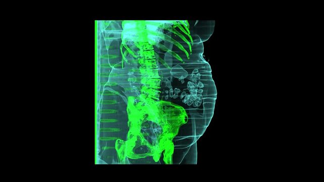 3D Green Volumetric NCCT KUB Scan Showing Lumbar Spine Pelvic Skeleton and Abdominal Intestinal Gas Patterns