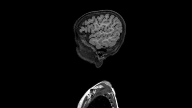 Sagittal Brain MRI Scan Scrolling View Showing Pediatric Brain Anatomy Corpus Callosum Brainstem and Cervical Spine