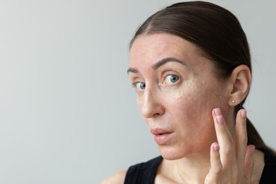 Woman shocked how looks her face after biorevitalization. 
