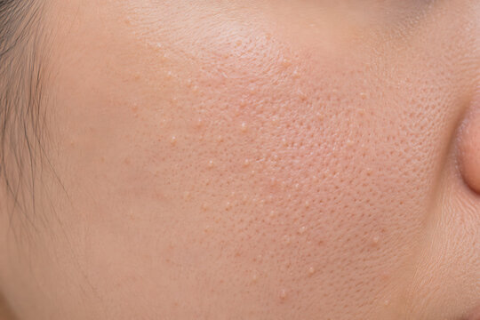 Macro Close Up of Closed Comedones on Asian Facial Skin