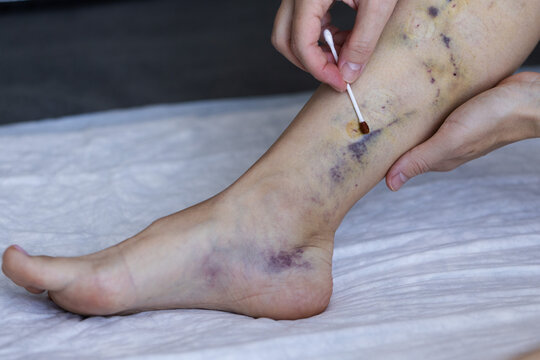 Post operative wound treatment. Close-up shot of patient legs