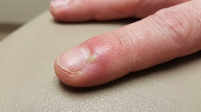 Paronychia Nail Fold Infection Realistic Clinical Dermatology Close Up Photograph