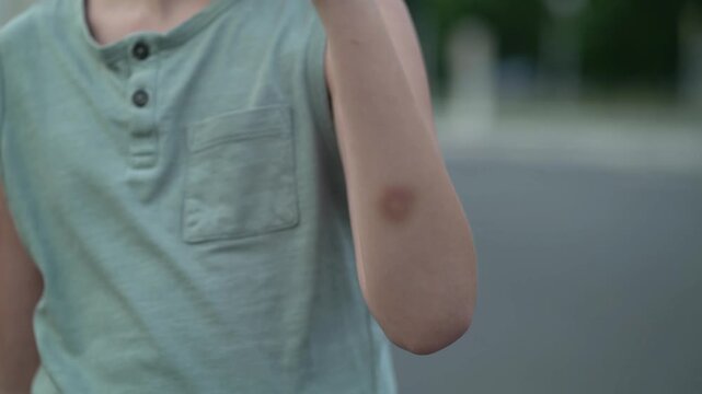 Young boy raises clenched fist outdoors, revealing a large purple bruise on his forearm after falling on the street on a sunny day.