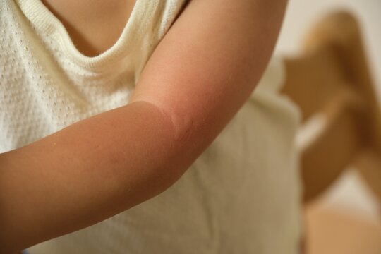 Redness and rash on the inside of a child's elbow