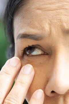 Middle aged Asian woman touching eyelid bump old aged health condition, eye closeup shot