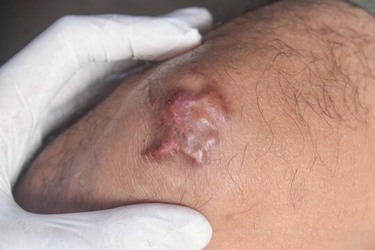 Keloid scar on adult male knee joint