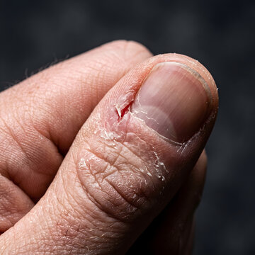 Thumb displays a painful hangnail with inflamed skin and peeling cuticles requiring medical attention.