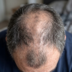 Fototapeta premium Man demonstrates significant hair thinning and pattern baldness on the crown of his head.