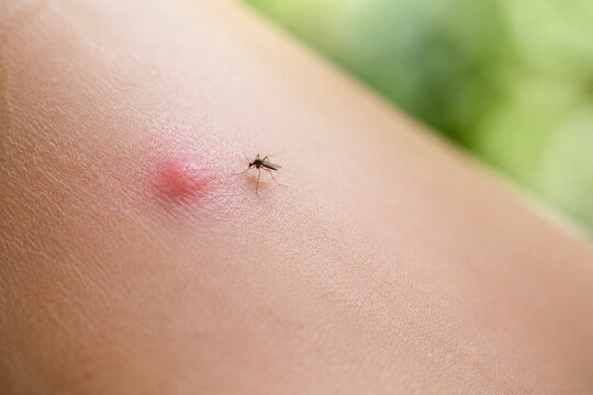 Mosquito bite bump and tiny mosquito on skin, pest irritation and health risk concept