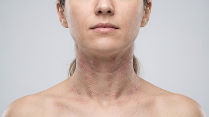 Naklejka premium Portrait of a woman with severe eczema, atopic dermatitis, or allergic skin reaction on her neck
