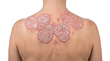 Naklejka premium Back View of Patient with Severe Plaque Psoriasis and Thick Scaly Skin Lesions