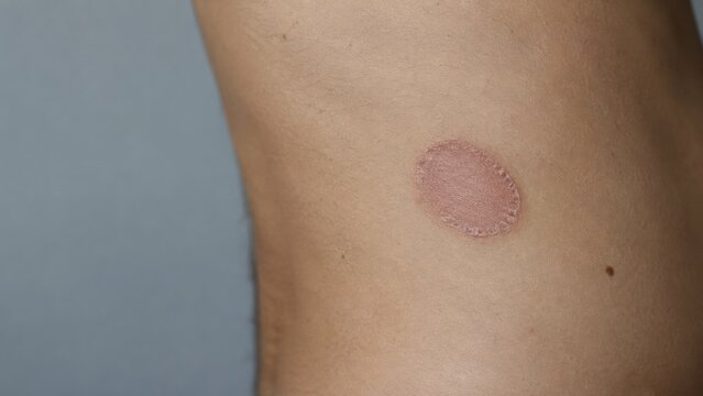 Close up of human skin with round healing wound covered by patched fabric on side torso area