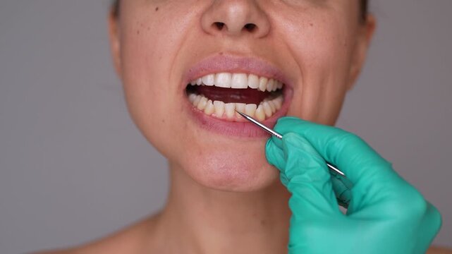 Close-up of open mouth while doctor's hand with dental tool points to tartar on lower teeth, showing plaque buildup, oral hygiene problem and dentistry concept on gray background