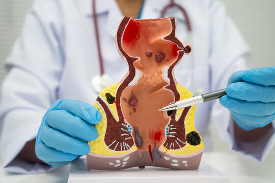 Asian doctor with rectum and hemorrhoid human anatomy model at hospital, inflamed vascular structure.
