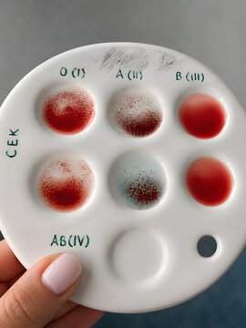 ABO blood typing test with blood samples on a laboratory test plate. Medical diagnostics, blood group identification, hematology and clinical laboratory concept.